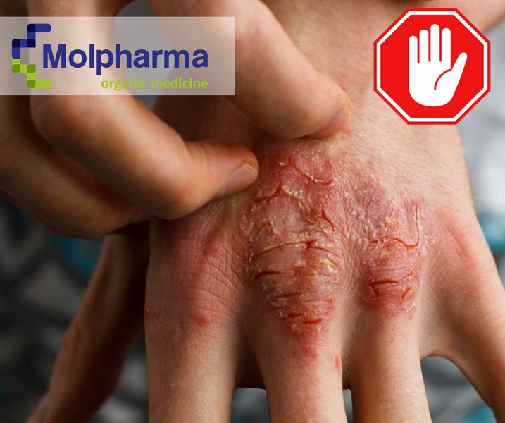 Jakich produktów unikać przy atopowym zapaleniu skóry?